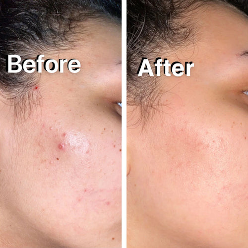 Elevelift Corrector 2.0